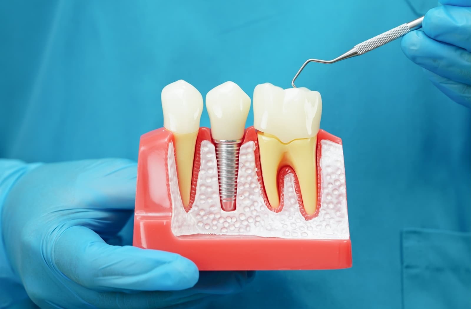 Close-up of a dentist in blue scrubs and blue gloves holding a model of teeth and a dental implant.