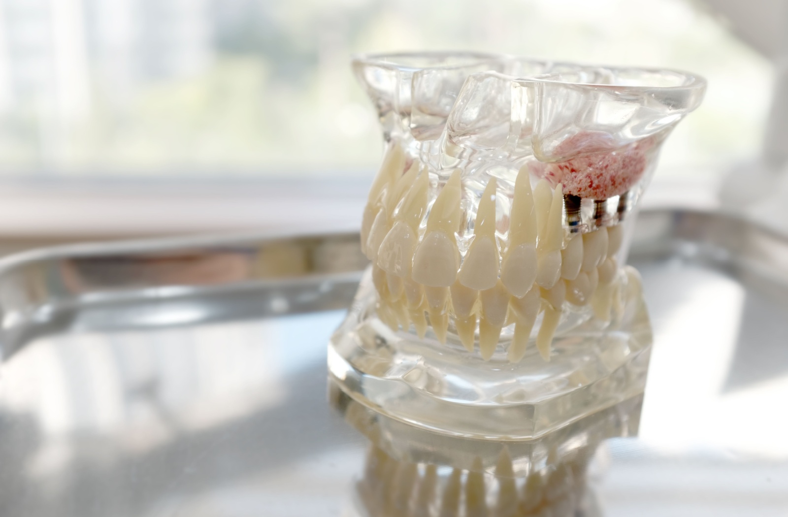 Close-up of transparent dental model showing jawbone and tooth structure with an embedded dental implant