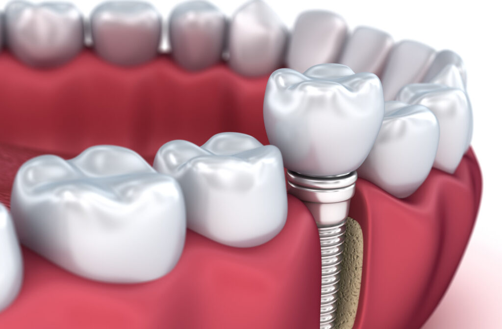 A rendering of a dental implant showing the titanium root.