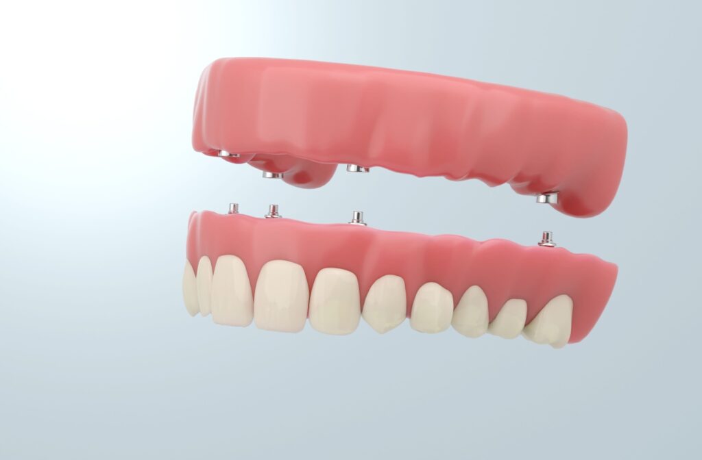 A 3D rendered image of a full mouth dental implant supported denture