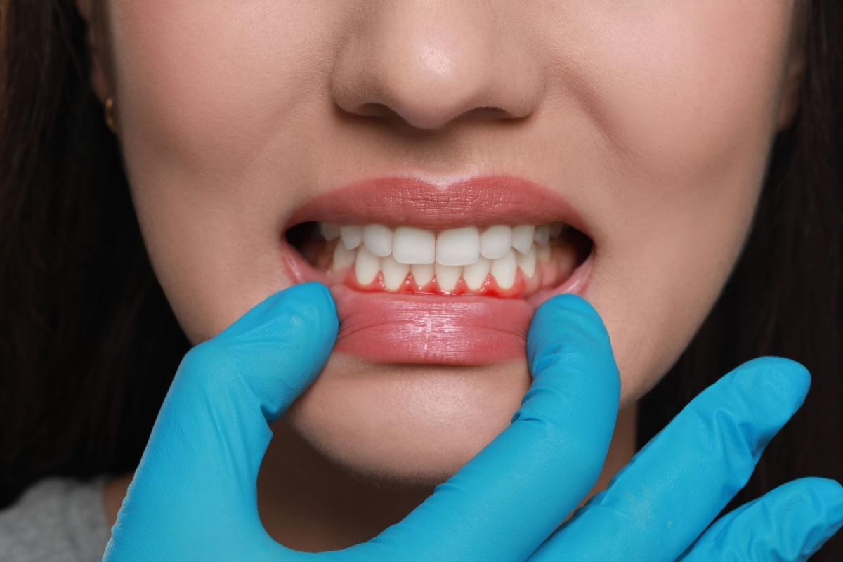 A person having their bottom lip gentle pulled down to show their inflamed gums